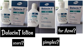 Dalacin T lotion Review Acne pimples ampscars [upl. by Ajat336]