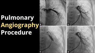 Angiography Procedure How It Detects Heart Blockages  Dr Priti Singhania Hindi [upl. by Pell]