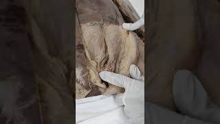 Dissection of Inguinal canal [upl. by Cho]