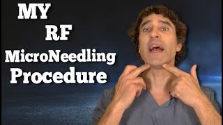 MY RF Microneedling RESULTS and EXPECTATIONS  Dr Rajani [upl. by Pet]