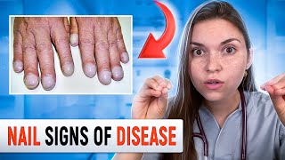 Doctor Explains what your NAILS say about your HEALTH Top 10 Nail Problems [upl. by Boswell745]