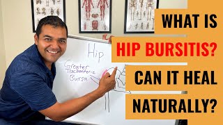 Injury Spotlight What is Hip Bursitis [upl. by Sherburne]