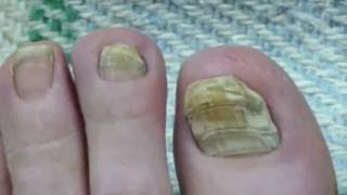 Toe Nail Fungus Cure 30 Months Progress [upl. by Abeh]