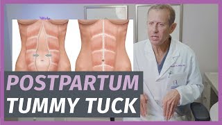 Postpartum Tummy Tucks Everything You Need To Know [upl. by Nnyltak]