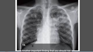 Tuberculosis Active TB  Chest x ray [upl. by Sair]