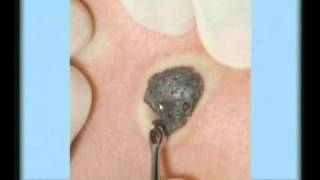 Seborrheic Keratosis Treatment [upl. by Dusen523]