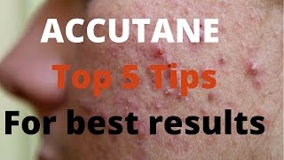 Accutane 5 tips by Dermatologists [upl. by Brandyn49]