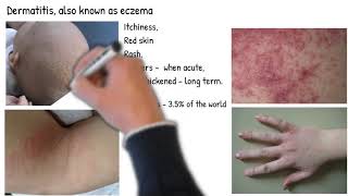 Dermatitis vs Eczema are they same Types of dermatitis symptoms prognosis and treatment [upl. by Amuwkuhc]