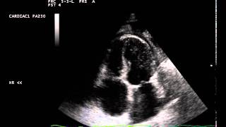 constrictive pericarditis septal bounce [upl. by Ashbey]