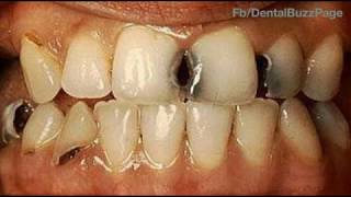 GV Blacks Classification of Dental Caries [upl. by Letnohs461]