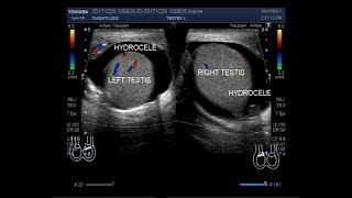 Hydrocele vs Varicocele vs Torsion vs Epididymitis vs Tumor [upl. by Aihk]