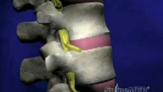 SpineMED® Decompression System Patient Education Video [upl. by Itteb]