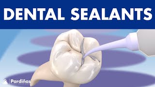 How to PREVENT CAVITIES  Dental sealants © [upl. by Mori]