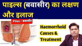 What Are Piles HEMORRHOIDS Causes Symptoms and Treatment  in Hindi [upl. by Eldwun905]