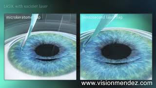 Laser Cataract Femtosecond Animation [upl. by Retep]