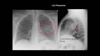 Chest Xray Cases 1 [upl. by Enieledam]