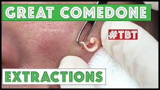 Greatest Blackheads and Whiteheads TBT [upl. by Muirhead]