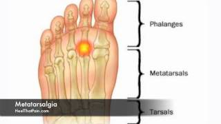 Metatarsalgia Foot Pain Causes Symptoms amp Treatments [upl. by Scheider]