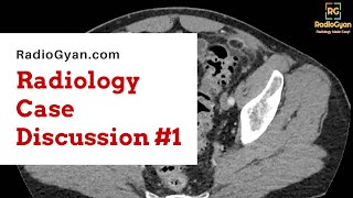 Acute Epiploic Appendagitis  Radiology Board Review Case [upl. by Argella]