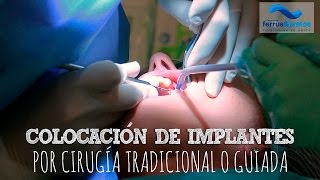 Colocación de implantes dentales [upl. by Aivatal206]