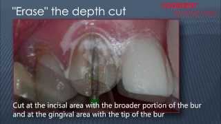 Composite Veneers Preparation [upl. by Eibur606]