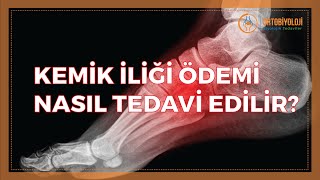 KEMİK İLİĞİ ÖDEMİ NASIL TEDAVİ EDİLİR [upl. by Neelhtakyram]