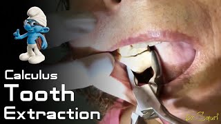 Calculus Tooth Extraction [upl. by Leoj]