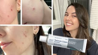 HOW I CLEARED MY SKIN IN 1 MONTH  Tretinoin Cream 0025 Before and After [upl. by Amitie]