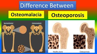 Difference Osteomalacia and Osteoporosis [upl. by Yelena39]