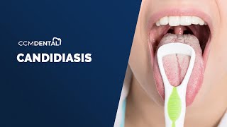 Candidiasis Oral  Síntomas causas y tratamiento por Javier Alberdi CCM Dental [upl. by Lennahs]