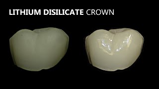 Porcelain Veneer Crown and Bridge Polishing [upl. by Ymas]