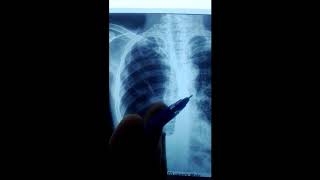 Hydropneumothorax  A case prepared by Prof Saleh AlAwdhaly [upl. by Annaej]