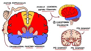 Middle Cerebral Artery Stroke Syndromes  MCA Stroke Syndromes With Gerstmann Syndrome amp Lesions [upl. by D'Arcy625]