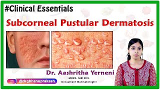 Subcorneal Pustular Dermatosis  Clinical Essentials   Dr Aashritha yerneni [upl. by Krall]