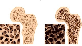 Osteoporosis [upl. by Nocaed]