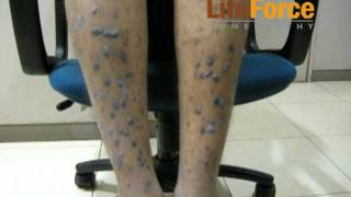 Severe Hypertrophic Lichen Planus with Severe Lichenification on Legs Treated at Life Force [upl. by Ettedualc]