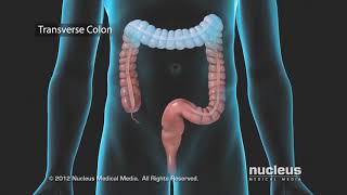 Colon Problems Diverticular Disease [upl. by Ellehcsor]