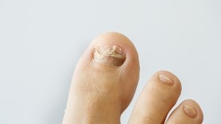 How to prevent and treat nail fungus [upl. by Katzman]