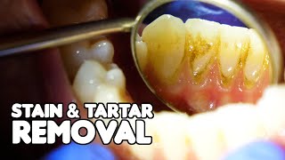 Dental Cleaning EXPLAINED  Stain amp Tartar Removal [upl. by Ozneral]