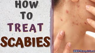 HOW TO TREAT SCABIESscabies treatment at home [upl. by Waylen921]