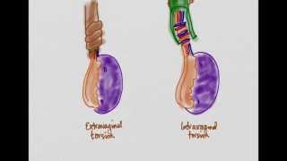 Testicular Torsion [upl. by Selwyn]