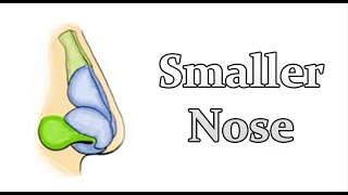 Pinched Narrow Nose Rhinoplasty to Address Nasal Obstruction [upl. by Ttirb]