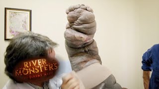 The Miracle Elephantiasis Treatment  HORROR STORY  River Monsters [upl. by Waynant]