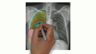 Comprendre lHydropneumothorax en Radiographie Thoracique 02 [upl. by Ynaffyt]