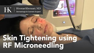 Skin Tightening of the Face using RadioFrequency RF Microneedling by Dr Hooman Khorasani [upl. by Semyaj]