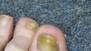 My Toenail Fungus Sucess Story [upl. by Essej]