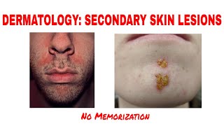 DERMATOLOGYSECONDARY SKIN LESIONSCRUST SCALE FISSURE EROSION ULCER USMLE MCC CLINICAL MEDICINE [upl. by Shel]