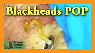 Blackheads POP  Auburn Medical Group [upl. by Niarb]