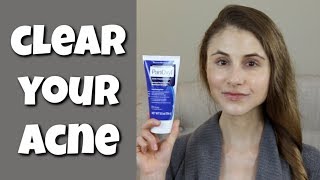 HOW TO CLEAR YOUR SKIN WITH BENZOYL PEROXIDE DR DRAY [upl. by Nidak]