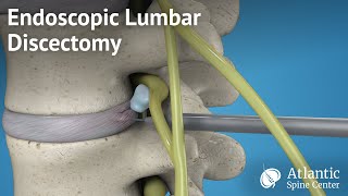 Endoscopic Lumbar Discectomy [upl. by Chandra]